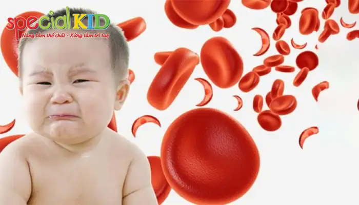 Dấu hiệu bệnh thiếu máu do thiếu sắt ở trẻ.